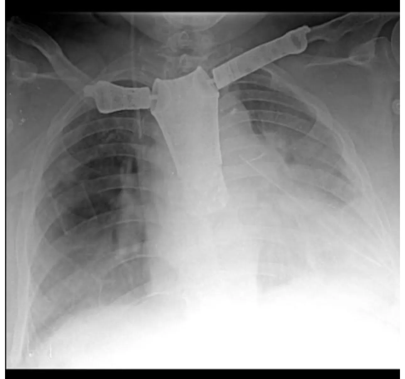 Operación de alta complejidad Hospital Ferreyra